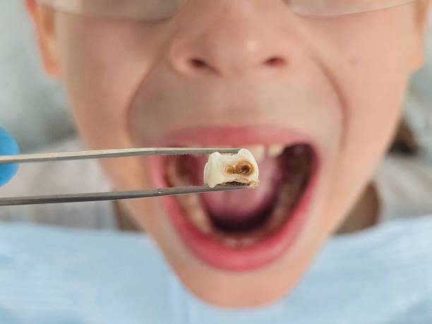 Best Emergency Root Canal Therapy in Whitesboro, TX